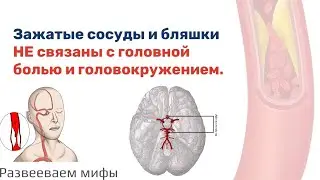 Зажатые сосуды и бляшки НЕ связаны с головной болью и головокружением. Развеиваем мифы.