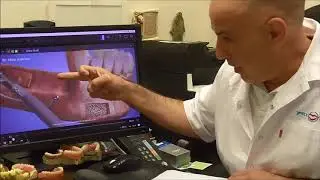 בניית עצם לפני השתלת שיניים באמצעות בלוקים