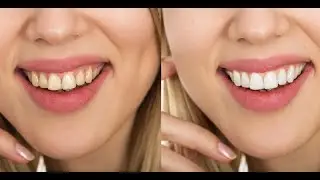 Whiten Teeth in 10 Seconds! 