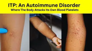 ITP (Immune Thrombocytopenia): The Autoimmune Disease Affecting Children And Adults Alike, Awareness