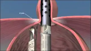Acid reflux surgery - EsophyX  animation