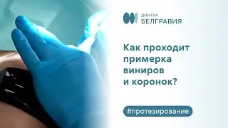 🧐 Как проходит примерка виниров и коронок?