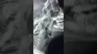 Adenoid and Tonsillar hypertrophy on lateral neck X ray