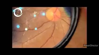 Ophthalmic Signs 461