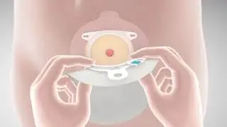 Coloplast SenSura Mio 2/ השמה וחיבור שקית סנסורה מיו 2 חלקים