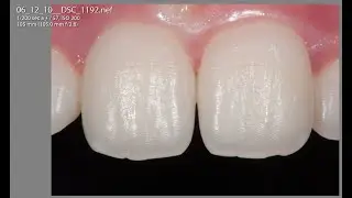 Diffrazione in odontoiatria: mito o realtà?
