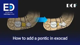 How to Add a Pontic in exocad