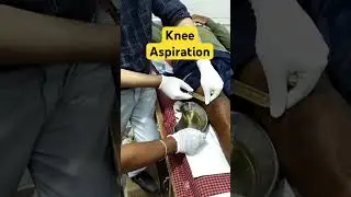 Knee aspiration in Old traumatic knee effusion #knee #injury #swelling #aspiration #opd #procedure