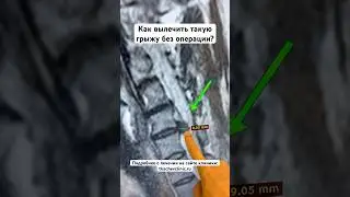 Large Herniated Disc in the Neck. How to Treat It. 