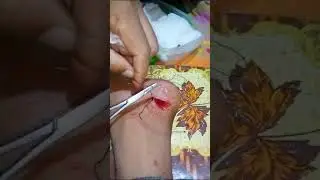 ইনজুরি অপারেশন