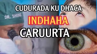 Xanuunada ku dhaca indhaha caruurta Dr.shiine