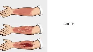 Первая помощь при термических ожогах