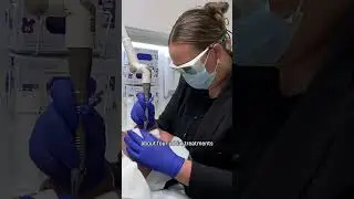 Tighten Skin Around Eyes with Smooth Eye Fotona Laser - Skin Treatment Chad Hurst