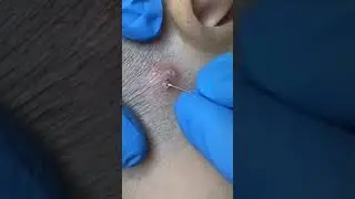 Самое залипательное видео давить прыщи Черные точки