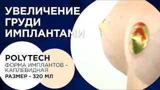 Зыков: Увеличение груди. Обьем 320 мл.