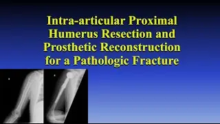 Intra-articular Proximal Humerus Resection and Prosthetic Reconstruction for a Pathologic Fracture