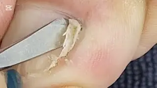 Tanggal ang malaking kuko nakabaon.