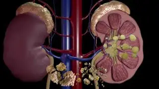 How to prevent kidney stones naturally or with medication