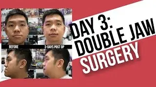 Day 3: Double Jaw Surgery Post-Op
