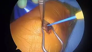 Uniportal VATS or RATS (Thoracoscopic or Robotic) access
