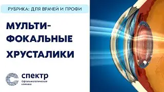 Мультифокальные хрусталики при лечении катаракты. Полное видео. Для пациентов и молодых коллег.