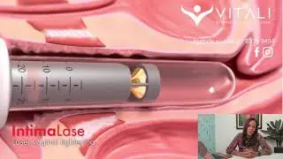 Tensado Vaginal procedimiento con láser fotona.