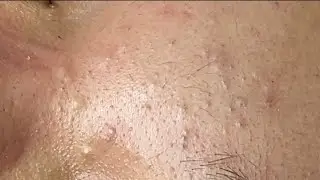 Inflammatory acne hematoma, hidden acne (Tham P.3) #HoangMySpa110