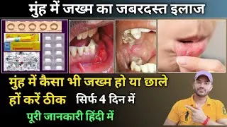 Treatment for mouth ulcer/मुंह में जख्म हो या हो छाले करें ठीक सिर्फ 4 दवाओं से जबरदस्त ट्रीटमेंट
