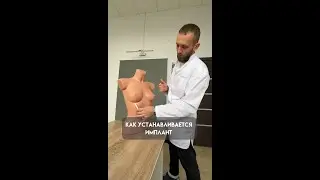 как устанавливается имплант