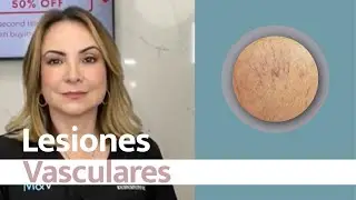 Las lesiones vasculares no solo son un problema estético❗