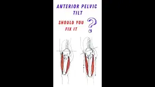 How to fix anterior pelvic tilt?