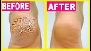Cracked heels cure | Home Remedies for Cracked Heels /remove cracked Hills fast & easily at home