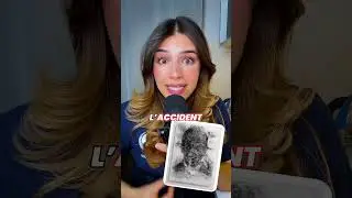 Il se perfore le crâne ! #thread #histoiremedicale #medstudent #pass #las #médecine