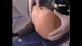 Инсульт!!! Как правильно оказать первую помощь!!!