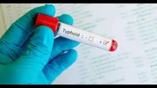 Health Talk On Typhoid Fever
