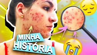 A HISTÓRIA das MINHAS ESPINHAS | atualizado #espinhas #acne #roacutan