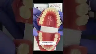 Конструктивные особенности аппарата Carriere Motion 3D🔥 #motion3D #брекеты #ортодонтия #ortodontia