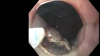 Rectal Endoscopic Submucosal Dissection (ESD)