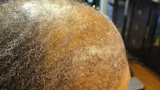 alopecia easy sew in pattern and net method (Beginner friendly)