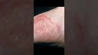 Terbinafin (lamifen) topical cream