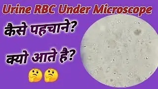 Red blood cells in urine | RBC in urine | RBC under microscope