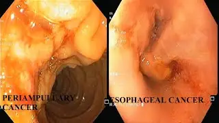 Synchronous carcinoma esophagous with periampullary carcinoma| Upper GI endoscopy| Side view scopy