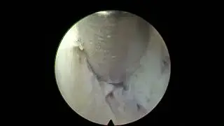 Full endoscopic interlaminar approach L5-S1