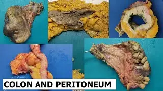 Colon cancer grossing #3 - Peritoneum and radial margin