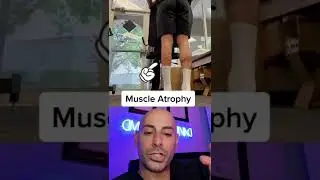 Leg Muscle Atrophy  