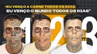 3º sessão de remoção do Leandro | Remoção de Tatuagem