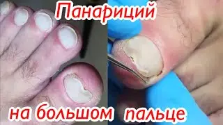 Панариций на большом пальце🦶🏻😯