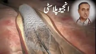 How Angioplasty and Angiography is performed: Animation