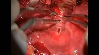 Transcranial traumatic CSF leakage repair