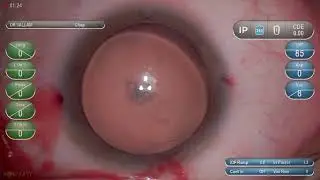 Soft Cataract Single handed Flip